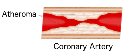coronary artery blockage